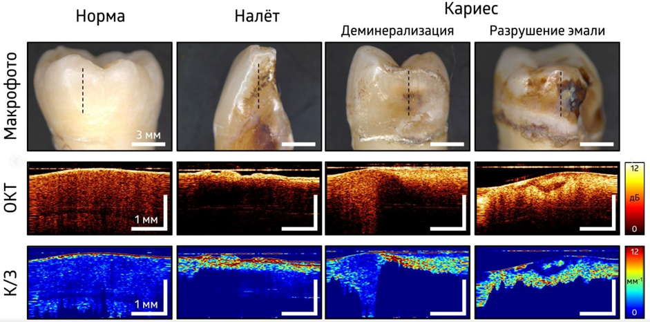 Методику экспресс-диагностики ранней стадии кариеса разработали в ПИМУ